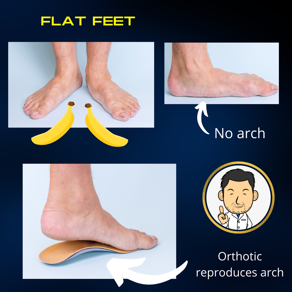 Treatment For Flat Feet