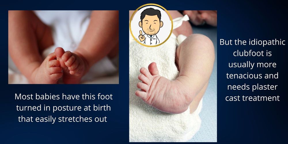 Clubfoot Treatment