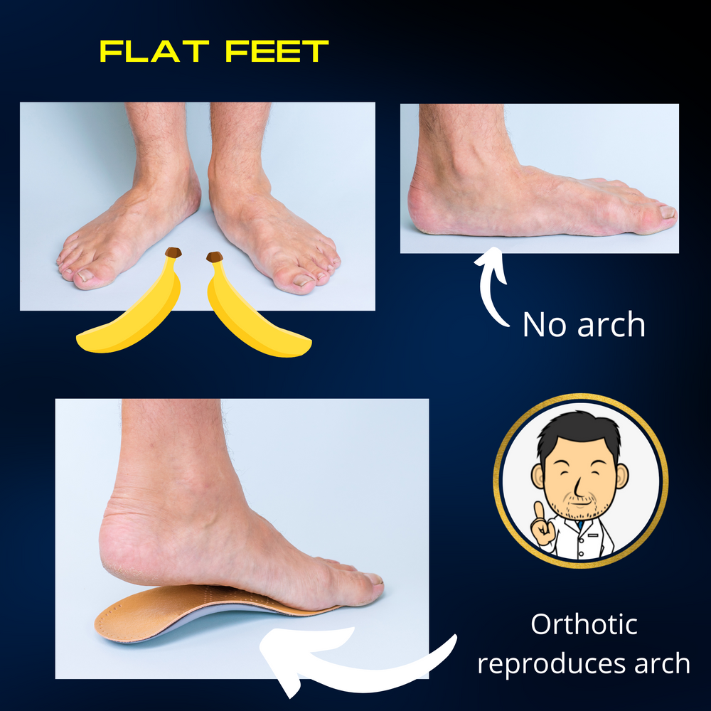 Treatment for Flat feet